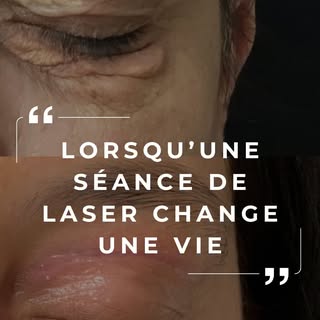Cette patiente vivait un vrai handicap social. 

Un xanthélasma sur toute la paupière. Plus de trava