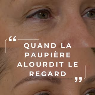 Quand la paupière alourdit le regard 👁️

Avec l’âge, la paupière supérieure peut se relâcher. 
J’ob