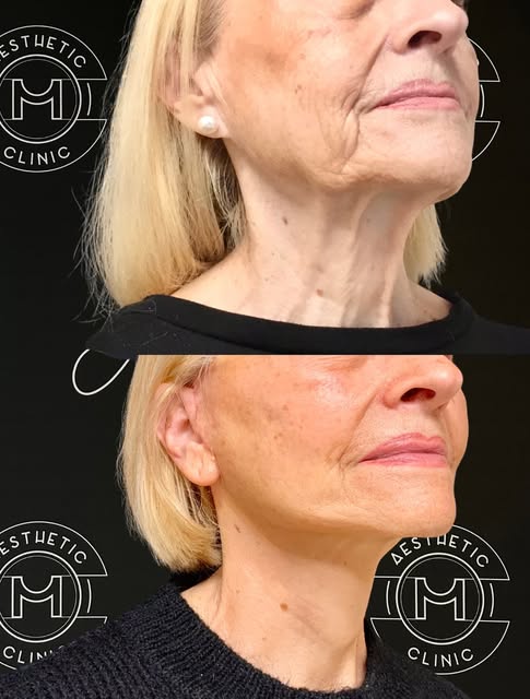 Elle est venue avec une demande simple : retrouver l’harmonie de son visage sans jamais paraître tra