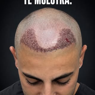 Lo que nadie te muestra del trasplante capilar.
 
 📅 Día 1: la cirugía.
 📅 Día 7: el cabello empie