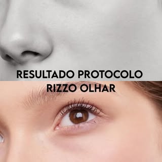 Mostrando a evolução de uma cirurgia que realizamos dentro do Protocolo Rizzo Olhar: blefaroplastia 