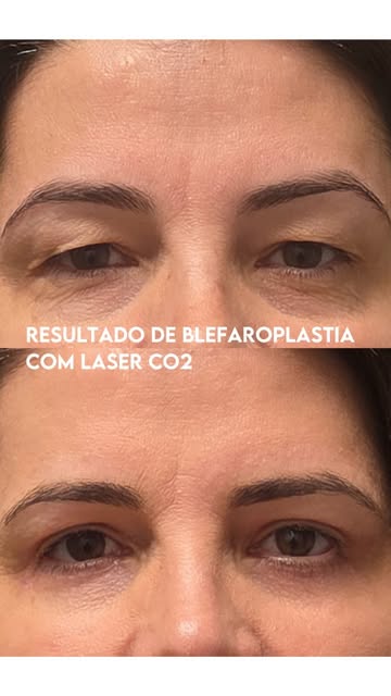 Naturalidade e elegância na blefaroplastia com laser de Co2 no Protocolo Rizzo Olhar. 

#Blefaroplas