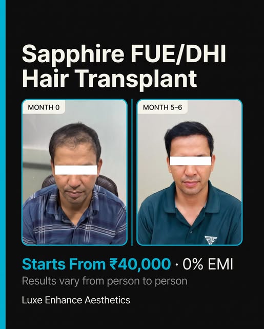 From thinning hair to a fuller, more confident look. ✨

This Sapphire FUE/DHI Hair Transplant transf