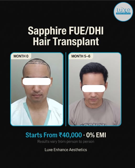 A new hairline. A new level of confidence. ✨

Witness this Month 0 → Month 5–6 transformation after 