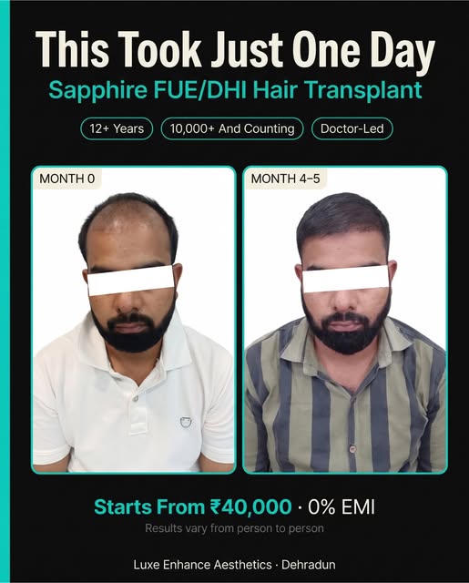 A hair transformation that speaks for itself. ✨

A closer look at this Sapphire FUE/DHI Hair Transpl