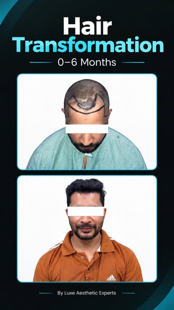 A well-planned hair transplant can help restore the hairline and create a fuller, more natural-looki