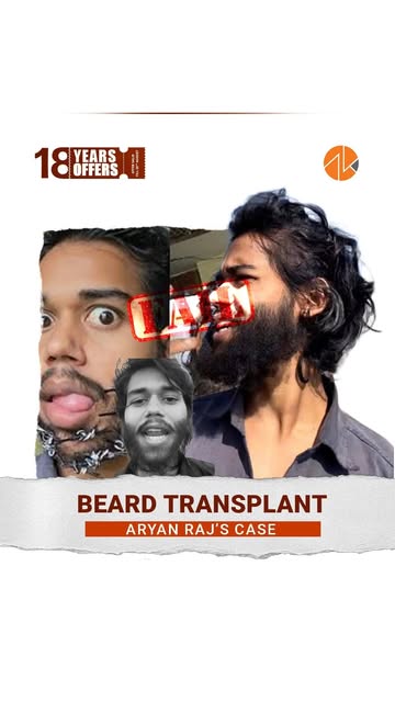 A Beard Transplant isn’t just about adding hair — it’s about creating a look that feels naturally yo