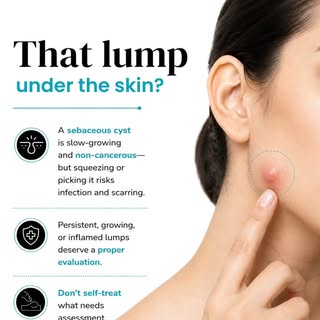 That lump under your skin may be a sebaceous cyst. While it is usually slow-growing and non-cancerou