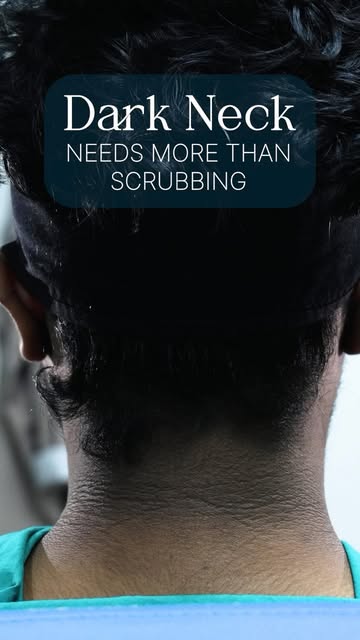 Dark neck? Stop scrubbing. Start treating the cause. 
Dark neck needs more than scrubbing. ✨

If you