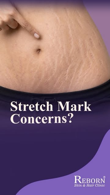The goal isn’t perfect skin. It’s skin you feel confident in ✨
 
Stretch marks are a natural part of