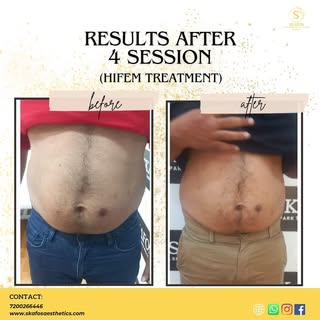 6” inch reduction in 4 sessions!! Feel the effect of 30,000 crunches in 30 minutes!! No operation !!