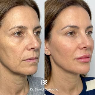 Tratamiento Antiaging ✨ realizado por nuestro doctor @dr.davidcardona 

Nuestra paciente se sometió 