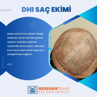 DHI SAÇ EKİMİ YÖNTEMİ CİLDE KESİ AÇMADAN AĞRISIZ VE ACISIZ BAŞARI ORANI EN YÜKSEK SAÇ EKİMİ YÖNTEMİD