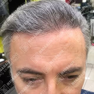 Değerli Hastamıza Saç Ekimi Yapılmıştır.Hastamızın Muhteşem Değişimi...

Değişiminiz Saçları