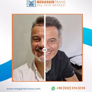 Hastamızın Saç Ekimi Sonrası Muhteşem Değişimi

Değişiminiz Saçlarınızda Başlasın ...! Sizleri K