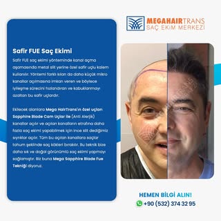 Safir FUE Saç Ekimi Nedir? Avantajları…

Değişiminiz Saçlarınızda Başlasın ...! Sizleri Kliniğim
