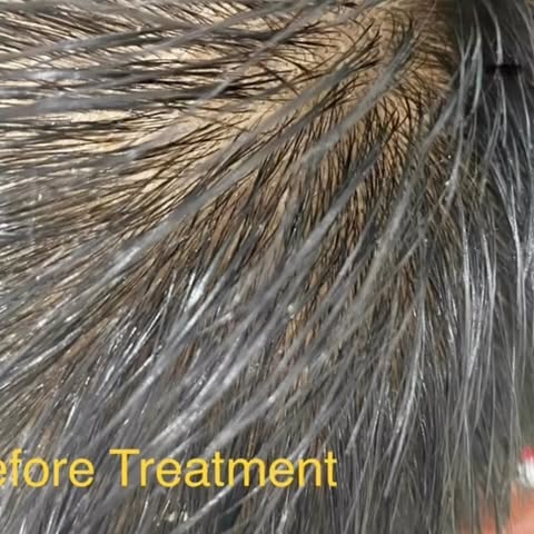 Anti Hair Loss Treatment/. Hair Fall Treatment / Hair ReGrowth Treatments