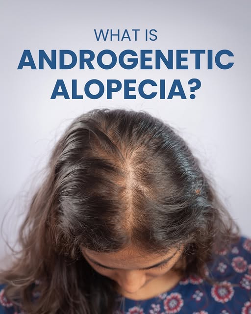 Androgenetic alopecia is the most common form of hereditary hair loss, affecting both men and women 