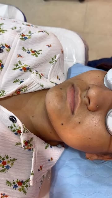 Ready to say goodbye to that unwanted mole?  Mole removal, performed with precision and care. ✨ Prof