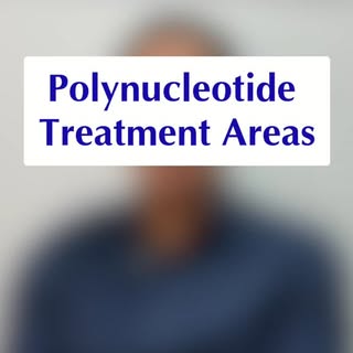 Polynucleotides = the glow-up your skin’s been waiting for ✨

Face ✔️
Neck ✔️
Décolletage ✔️
Under e