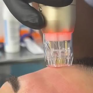 Midface = where the magic happens ✨
RF microneedling is one of the most effective ways to target vis