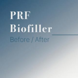 Before ➡️ After ✨
Under eyes refreshed with PRF biofiller for a natural, brighter look using your bo