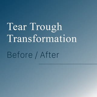 Tear trough transformation ✨
“Under eye filler is scary” is one of the most common myths we hear but