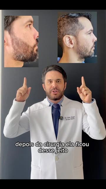 Transplante de barba não é só para você que não tem pelo algum na face. Também serve para você que j