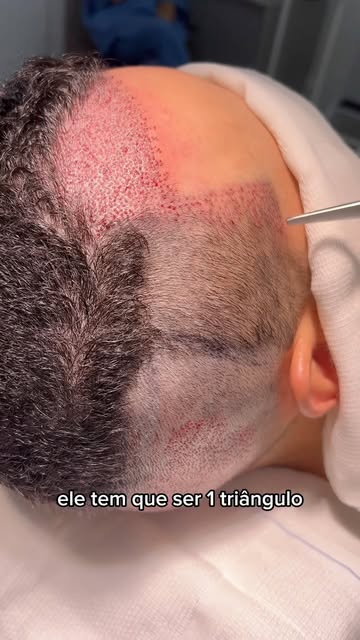 Você sabe o que é pico temporal e quando se deve corrigir ? Assista ao vídeo.