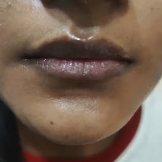 Dark lips are a thing of the past!
With new 532nm advanced Q switched ND-YAG laser, we can lighten t