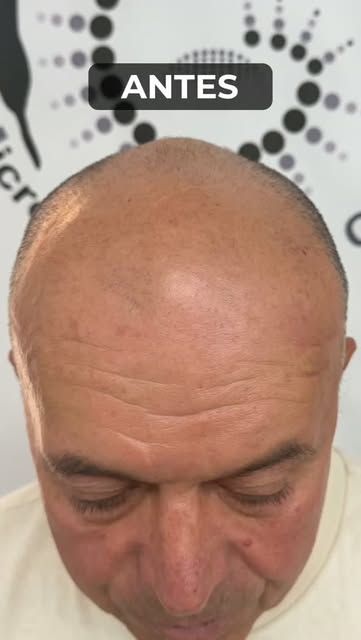 Micropigmentación Capilar
Isabel Gómez, Alicante

WhatsApp 667 640 118

Acabamos el viernes con esta