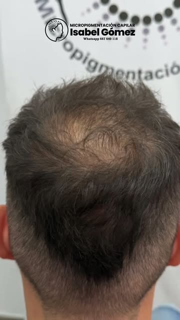 Micropigmentación Capilar
Isabel Gómez, Alicante
WhatsApp 667 640 118

Dándole la densidad que le fa