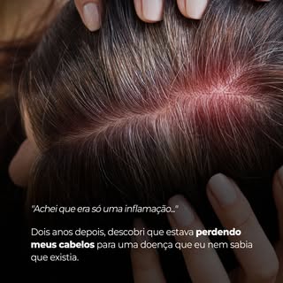 Você já teve algum sintoma no couro cabeludo que ninguém conseguiu explicar?

Leia até o final para 