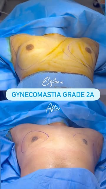 Why choose Dr Sreekar Harinatha? @dr.sreekar.harinatha 
✔ Focused expertise in gynecomastia correcti