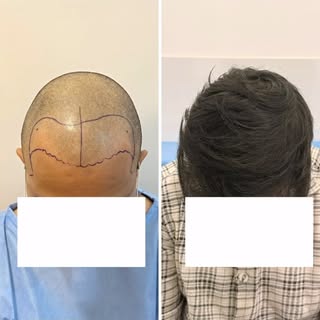 Follow @dr.sreekar.harinatha Natural Hair. Natural Confidence.

Every transformation begins with a s