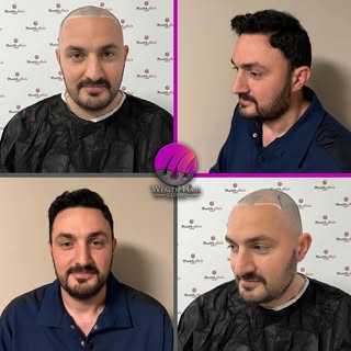 ✨ Yeni saçlar, yeni bir başlangıç! ✨

Hastamızın dönüşüm süreci inanılmaz! Profesyonel ekibimiz tara