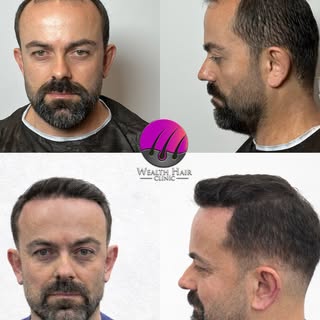 ✨ Gerçek sonuçlar, gerçek değişim!

Wealth Hair Clinic ile saç ekimi sonrası farkı siz de görün.

Ön