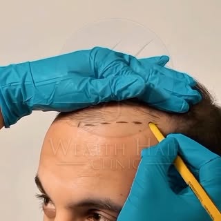 Gerçek sonuçlar. Gerçek değişim.
Seyrek saçlardan özgüvenli bir görünüme ✨

Wealth Hair Clinic’te he