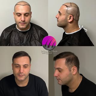 ✨ Gerçek sonuçlar, gerçek değişim!

Wealth Hair Clinic ile saç ekimi sonrası farkı siz de görün.

Ön