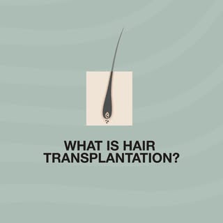 ⚫ Hair transplantation is a surgical technique during which hair follicles are harvested from hair-d