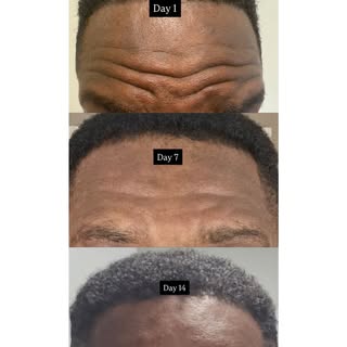 ✨ Botox Timeline: What to Expect ✨
Here’s a quick breakdown of how neuromodulator injections (aka Bo