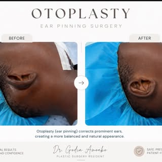 Subtle changes. Lasting confidence. 👂✨

Prominent ears can affect confidence at any age. Otoplasty 