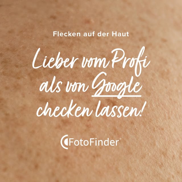 Flecken auf der Haut können viele Ursachen haben – von harmlosen Pigmentveränderungen bis hin zu ern
