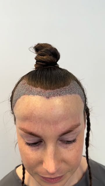 FEMALE HAIR TRANSPLANT

At Hair Doctors, female hair transplants are tailored to each individual pat