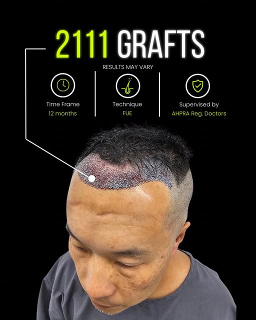 𝗛𝗮𝗶𝗿 𝗧𝗿𝗮𝗻𝘀𝗽𝗹𝗮𝗻𝘁 | 𝗖𝗹𝗶𝗻𝗶𝗰𝗮𝗹 𝗖𝗮𝘀𝗲 𝗦𝘂𝗺𝗺𝗮𝗿𝘆

A patient presenting with 