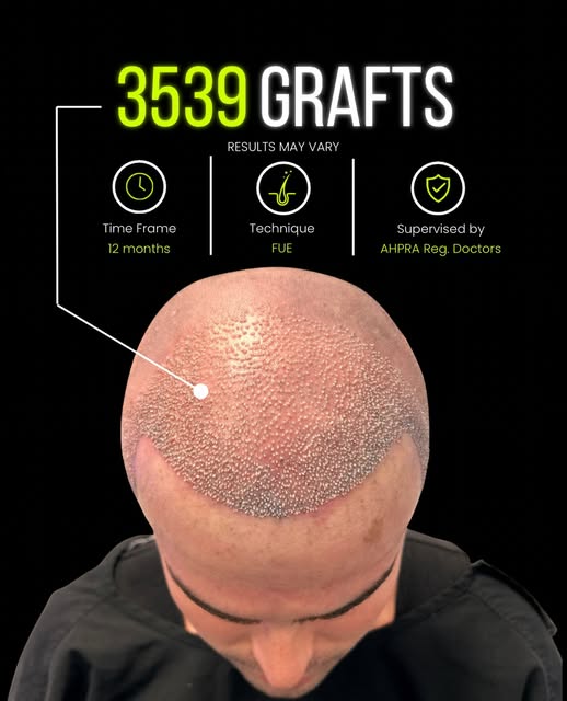 𝗛𝗮𝗶𝗿 𝗧𝗿𝗮𝗻𝘀𝗽𝗹𝗮𝗻𝘁 | 𝗖𝗹𝗶𝗻𝗶𝗰𝗮𝗹 𝗖𝗮𝘀𝗲 𝗦𝘂𝗺𝗺𝗮𝗿𝘆

A patient presenting with 