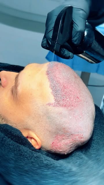 2,100 grafts to the frontal hairline.. getting ahead of hair loss before it progresses further. 🙌🏼