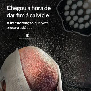 No Instituto de Transplante Capilar de Ribeirão Preto, cada paciente é atendido de forma individuali
