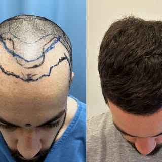 Acompanhem essa evolução!🙏

Nosso paciente mora no Canadá e realizou seu procedimento conosco há 15
