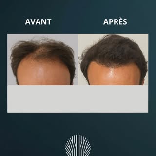 Comparatif « Avant / Après » montrant l’évolution de la densité capillaire de notre patient.
 Ce vis